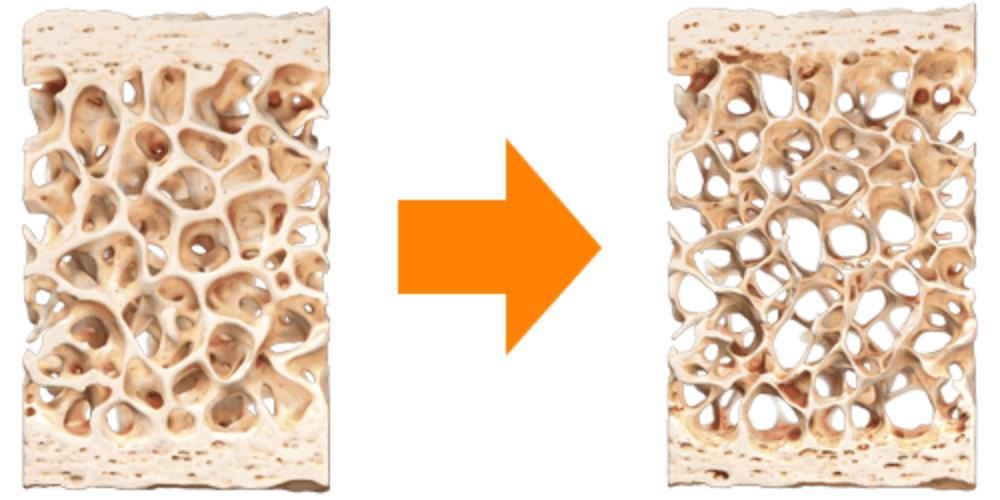 When osteoporosis occurs, more bone is being removed than added leading to a reduction in bone density